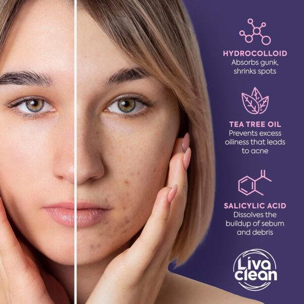 81NzPT6CCaL._SL1500_.jpg Livaclean 240CT Star Pimple Patches for Face w/ Hydrocolloid, Tea Tree oil & Salicylic Acid - Zit Stickers, Hydrocolloid Acne Patches for Face - Cute Pimple Patch, Acne Stickers