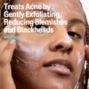 91vUNzCbKTL._SL1500_.jpg Cetaphil Gentle Clear Pore Clearing Acne Cleanser, Foaming Gel Cleanser for Sensitive, Acne-Prone Skin, 8 Fl Oz Pump Bottle, 2% Salicylic Acid, Gently Exfoliates, Dermatologist Recommended Brand